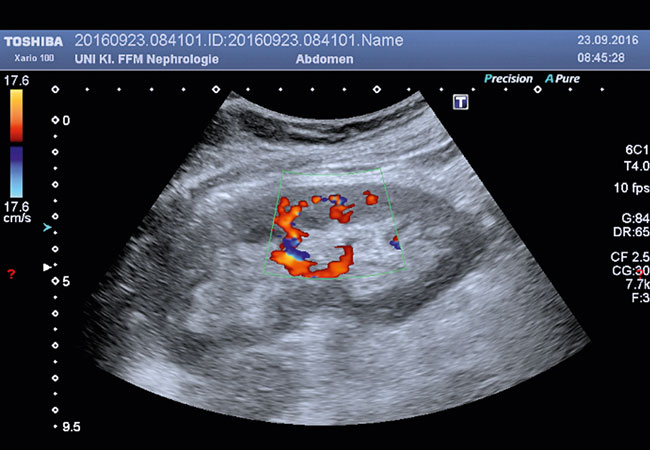 Farbdoppelultraschalbild einer Transplantatniere mit guter Durchblutung.