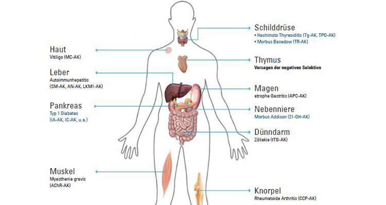 APS-2 im Körper: Ein autoimmunpolyglanduläres Syndrom kann die verschiedensten Organe des Körpers betreffen und dabei unterschiedliche Autoimmunerkrankungen auslösen; Grafik: Anna Kraus.