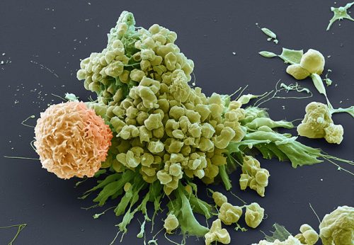 Attacke durch CAR-T-Zelle: Leukämiezellen (1) werden durch eine gentechnisch veränderte T-Zelle angegriffen, die sich zunächst an eine Tumorzelle anheftet (2) und dann Zellgifte in diese injiziert (3), woraufhin die Leukämiezelle in Partikel zerfällt (4). Foto: Science Photo Library/EYE OF SCIENCE