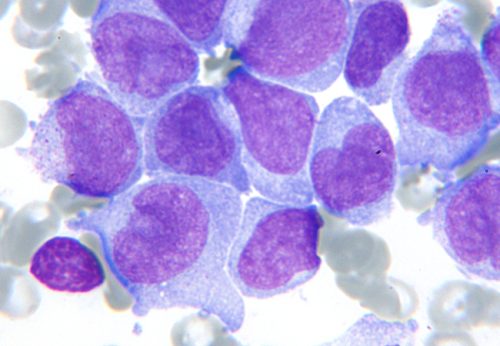 Knochenmarkausstrich eines Kindes, das an einer Leukämie erkrankt ist. Die violett gefärbten unreifen Leukämiezellen (Blasten) verdrängen die normale Blutbildung. Foto: Jan-Henning Klusmann, Universitätsklinikum Frankfurt