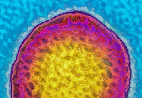 Häufig nicht eindeutig: Ein Fünftel der Menschen, die mit dem Hepatitis-C-Virus infiziert sind, haben keine auffälligen Leberwerte – dafür aber zum Teil rheumatische Beschwerden. Foto: James Cavallini/Science Photo Library