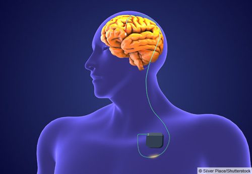 Eine Darstellung von einer Person mit einem Hirnschrittmacher © Silver Place/Shutterstock